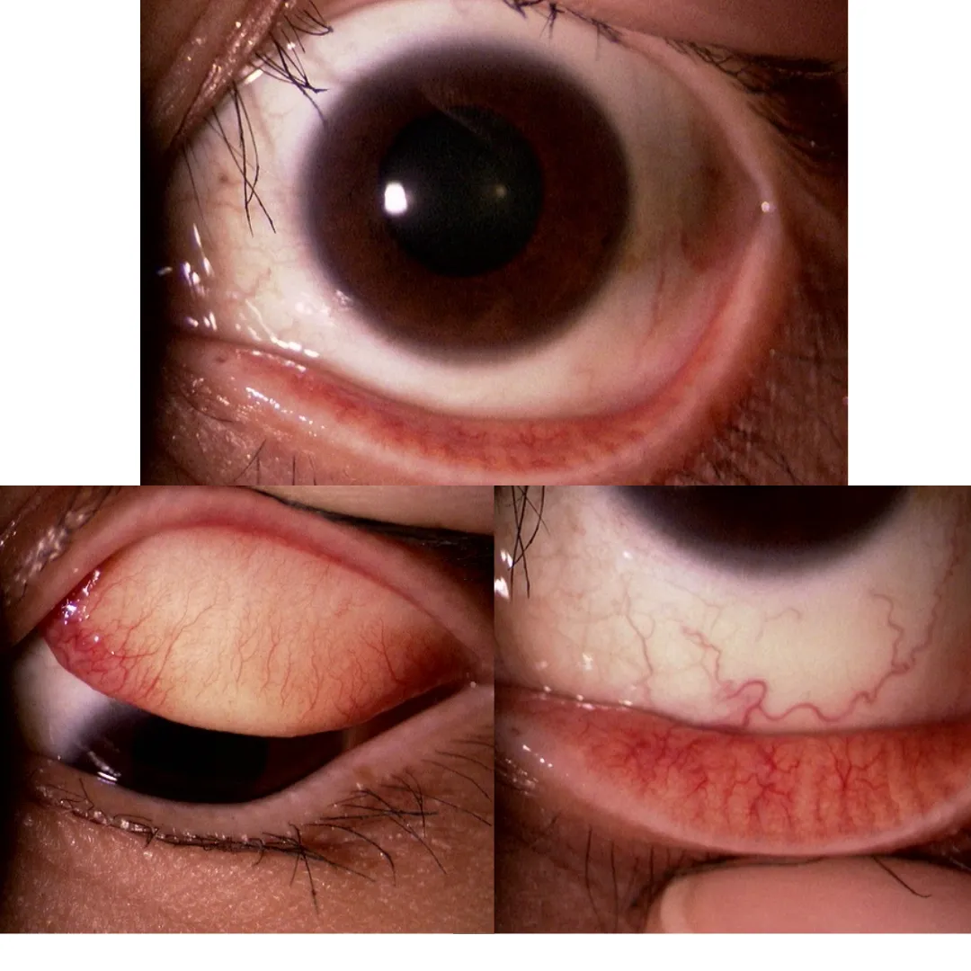 充血を取る点眼”マイティア ルミファイ”はどのくらい効果があるのか〈横浜市 梅の木眼科クリニック〉